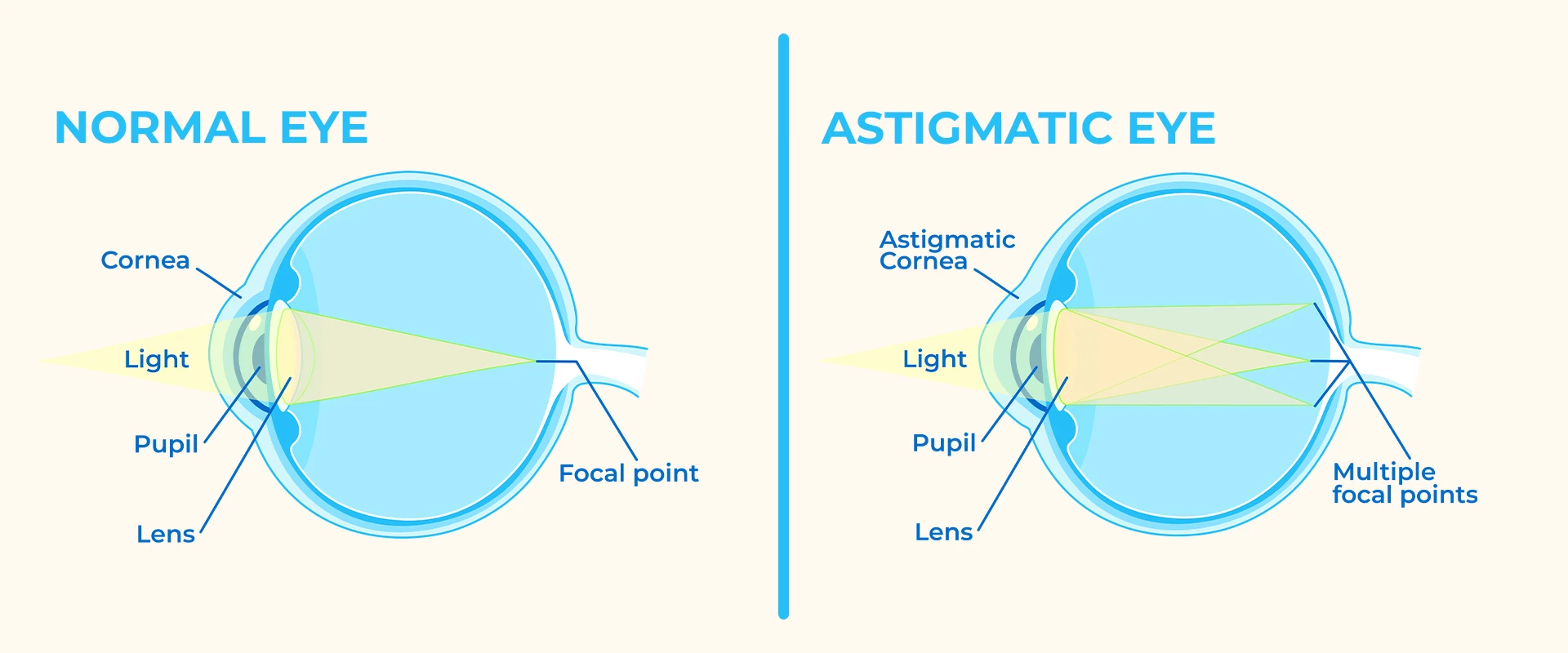 normal vs astigmatism eyeball